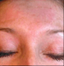 eye-after-2